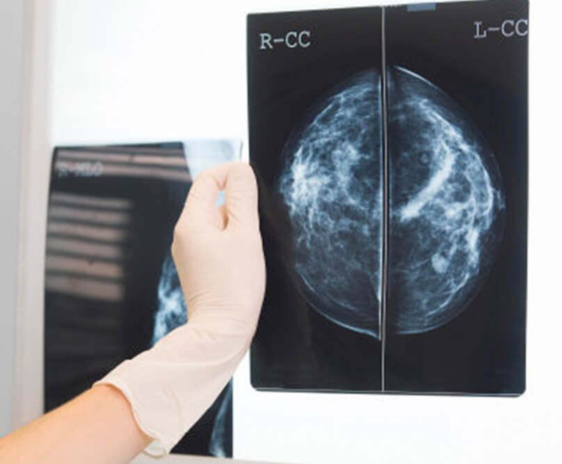 Είναι η χημειοθεραπεία πάντα απαραίτητη σε ασθενείς με καρκίνο μαστού